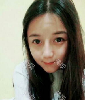 韓式隆鼻整形真實(shí)恢復(fù)期圖片，自然不夸張