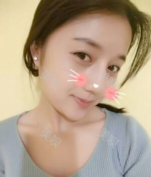 韓式隆鼻整形真實(shí)恢復(fù)期圖片，自然不夸張