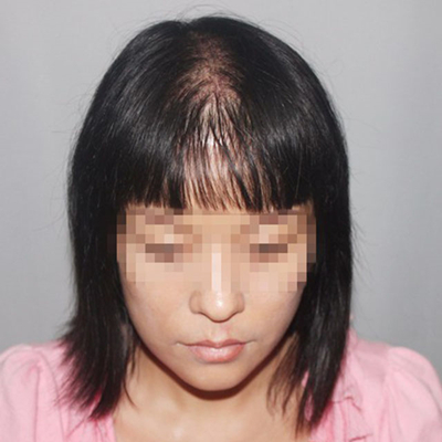 杭州金銀磊頭發(fā)種植案例