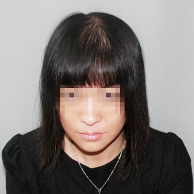 杭州金銀磊頭發(fā)種植案例