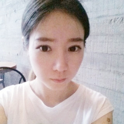 武漢五洲美萊劉楊切開雙眼皮案例