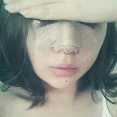 武漢五洲美萊周旭剛隆鼻整形案例