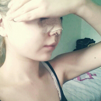 武漢五洲美萊周旭剛隆鼻整形案例