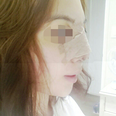 武漢五洲美萊周旭剛隆鼻整形案例