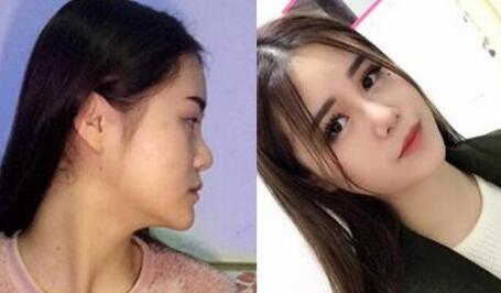 隆鼻前后對(duì)比圖