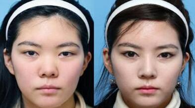 隆鼻的價(jià)格受到很多因素的影響