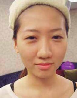 割雙眼是為了解決我大小眼的問題