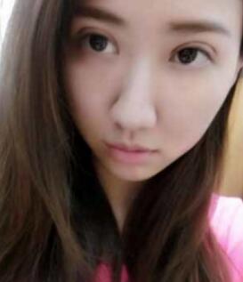 白天做的割雙眼皮手術(shù)