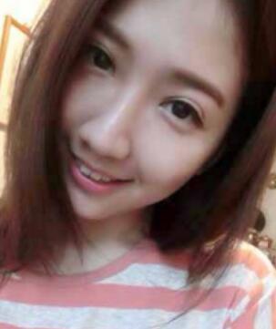 大小眼割雙眼皮手術(shù)果圖和恢復(fù)過程分享