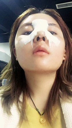 歪鼻矯正+假體隆鼻前后手術(shù)過程圖片分享