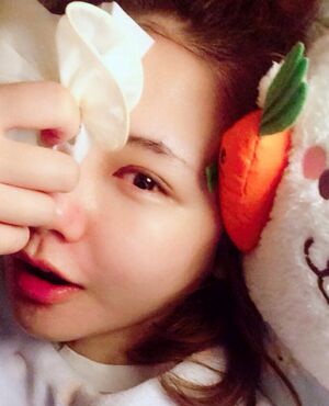 韓式定點(diǎn)雙眼皮前后對(duì)比圖，雙眼有神多了