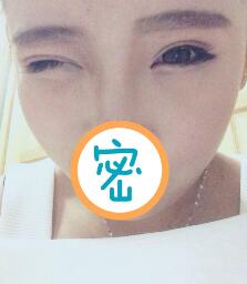 切開雙眼皮2個(gè)月，已經(jīng)完全恢復(fù)了