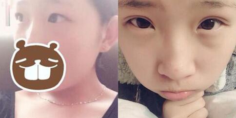 切開雙眼皮前后對(duì)比圖