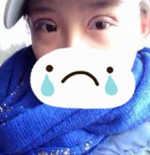 割雙眼皮手術(shù)