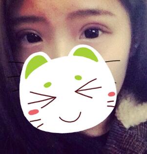 割雙眼皮第四天