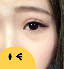 割雙眼皮第10天