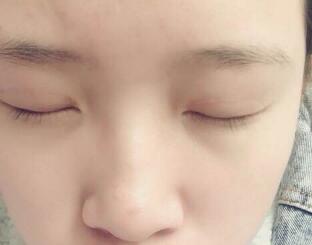 切開雙眼皮20天，雙眼皮的疤痕已經(jīng)很淡了
