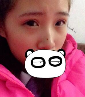 割雙眼皮恢復(fù)圖