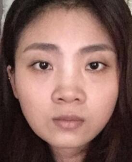 鼻子整形過程恢復(fù)圖片，真實(shí)案例分享