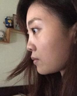 鼻子整形過程恢復(fù)圖片，真實(shí)案例分享