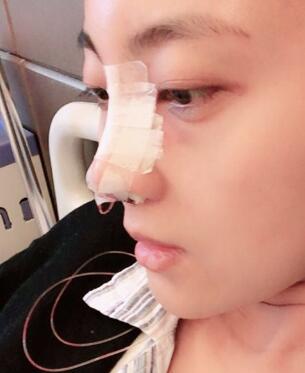 鼻子整形過程恢復(fù)圖片，真實(shí)案例分享