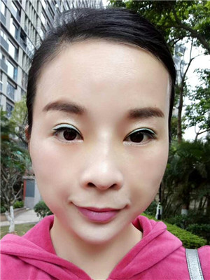 你們來看看我的面部埋埋蛋白線.提升術恢復情況