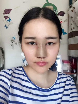 給你們分享隆鼻整形手術恢復過程