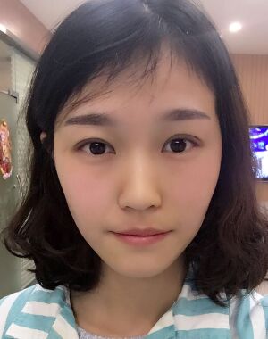 韓式微創(chuàng)雙眼皮恢復(fù)圖，超自然微創(chuàng)跡