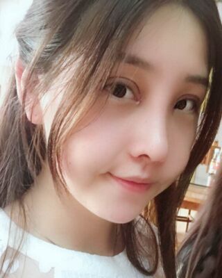 全切雙眼皮+開眼角前后對比照片圖