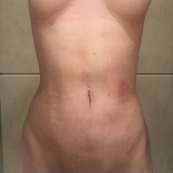 腹部環(huán)吸整形恢復果圖  我的減肥逆襲史