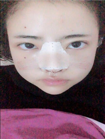 我的隆鼻整形恢復(fù)果圖  塌鼻子逆襲記