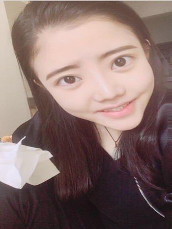 我的隆鼻整形恢復(fù)果圖  塌鼻子逆襲記