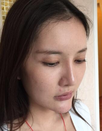 這是我做埋埋蛋白線.提升前拍的照片，看得出來(lái)面部肌膚走向下垂，皮膚松弛了