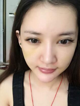 面部面b提升恢復(fù)日記和恢復(fù)圖片，一周左右恢復(fù)自然