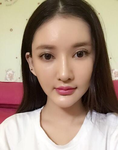 面部面b提升恢復(fù)日記和恢復(fù)圖片，一周左右恢復(fù)自然