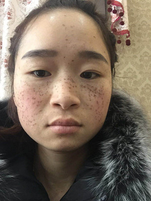 激光祛雀斑真實(shí)案例以及前后對比圖分享——?？诩t妝李杰做的