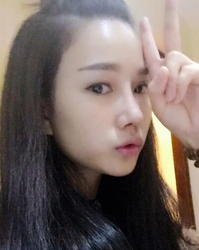 隆鼻整形真實恢經(jīng)歷 曬圖啦！