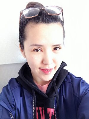 全切雙眼皮修復(fù)恢復(fù)后圖片，寬度較為合適喲