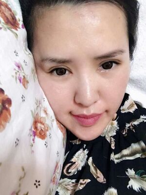 全切雙眼皮修復(fù)恢復(fù)后圖片，寬度較為合適喲