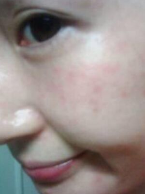 激光去雀斑果好不好，真實案例告訴你