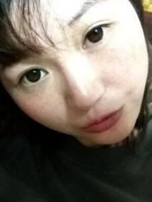 激光去雀斑果好不好，真實案例告訴你