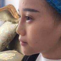 玻尿酸填充臥蠶果對(duì)比圖，很滿意