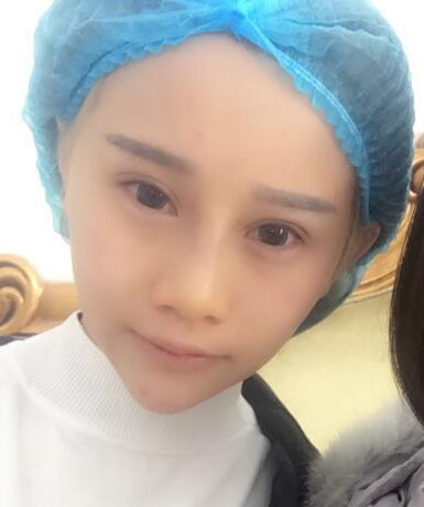 玻尿酸填充臥蠶果對(duì)比圖