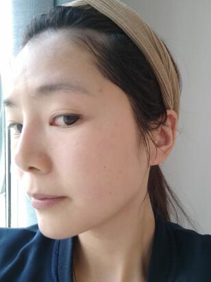 做完光子嫩膚恢復(fù)圖片和過程分享，光子嫩膚價格3800元