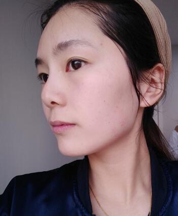 做完光子嫩膚恢復(fù)圖片和過程分享，光子嫩膚價格3800元