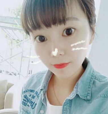 做完光子嫩膚恢復(fù)圖片和過程分享，光子嫩膚價格3800元