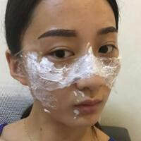 有誰做過激光祛雀斑？個人激光祛雀斑后恢復(fù)日記分享