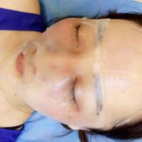 有誰做過激光祛雀斑？個人激光祛雀斑后恢復(fù)日記分享