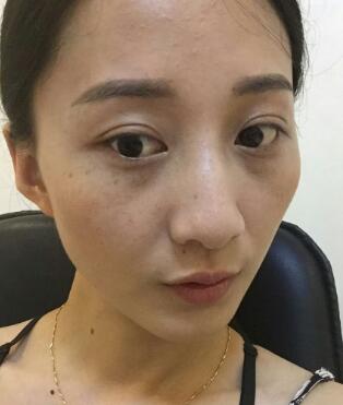有誰(shuí)做過(guò)激光祛雀斑？個(gè)人激光祛雀斑后恢復(fù)日記分享