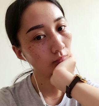 有誰(shuí)做過(guò)激光祛雀斑？個(gè)人激光祛雀斑后恢復(fù)日記分享